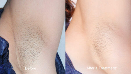 Laser Hair Removal Before and After