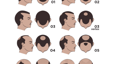 What is NW3 Hair?